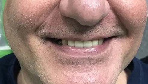 Dental Bridge & Crown after
