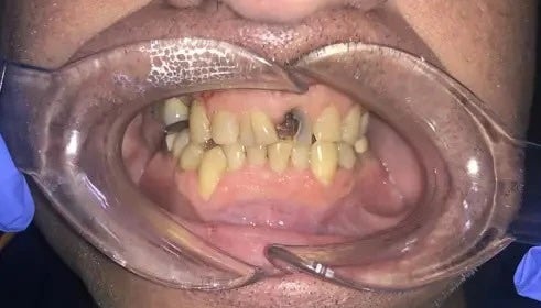 Dental Bridge & Crown before