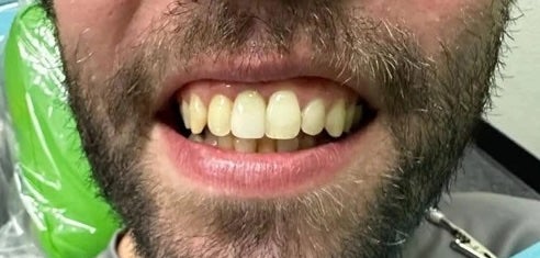 Implant Crowns after
