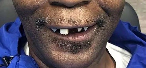 Implant-supported overdenture before