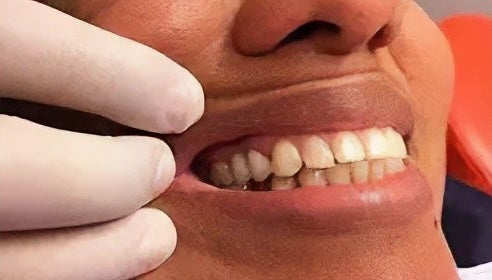 Single Implant after