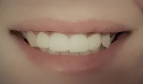 Root canals, Implants, and Crowns after