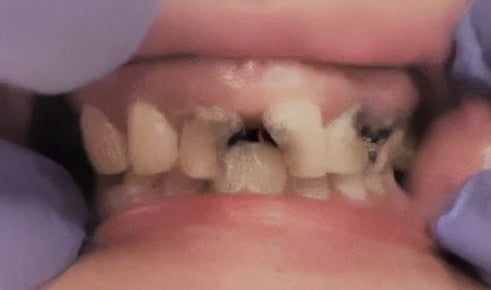 Root canals, Implants, and Crowns before