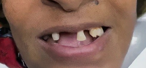 Implant-supported Denture 2 before