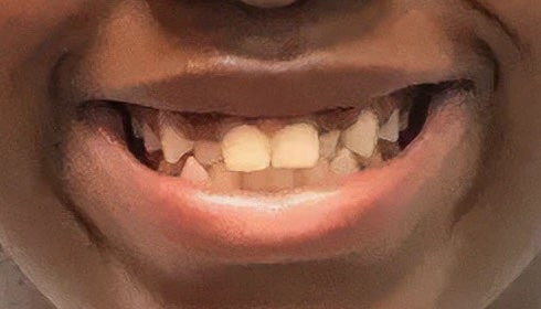 Zoom Teeth Whitening before