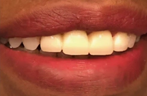 Dental Bridge 1 after