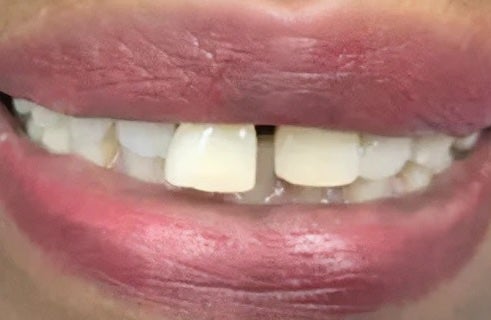 Dental Bridge 1 before