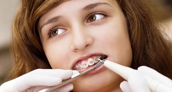 How To Brush Teeth With Braces